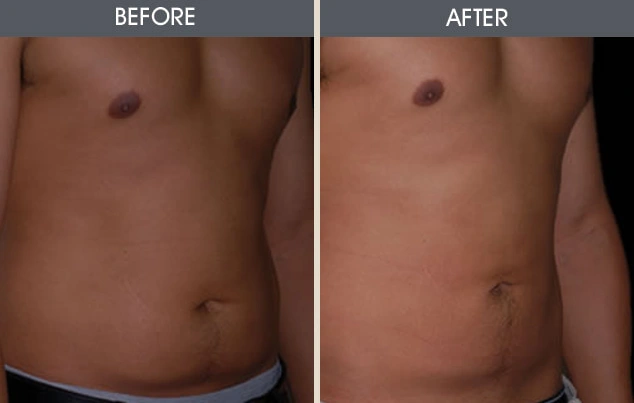 Real patient results in New York, NY Performed by Darrick E. Antell MD, FACS