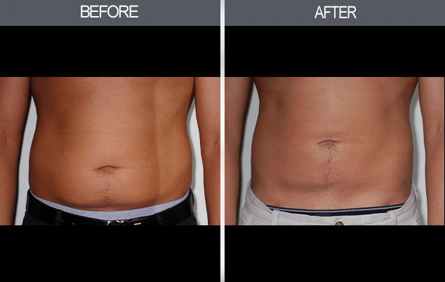 Real patient results in New York, NY Performed by Darrick E. Antell MD, FACS
