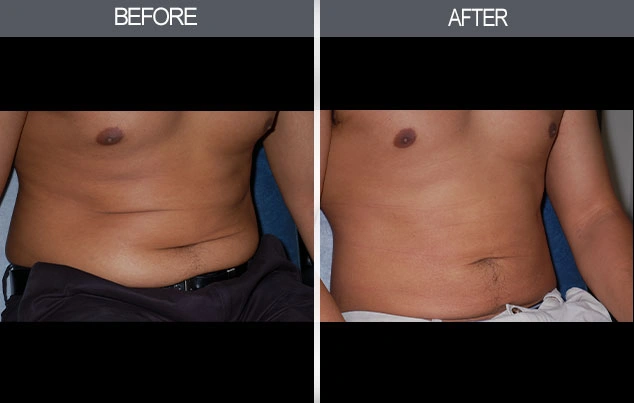 Real patient results in New York, NY Performed by Darrick E. Antell MD, FACS