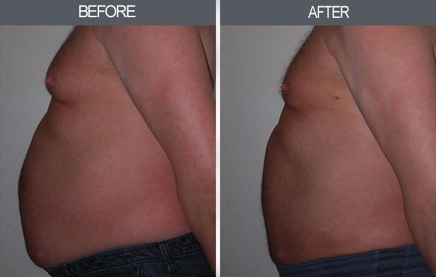 Real patient results in New York, NY Performed by Darrick E. Antell MD, FACS