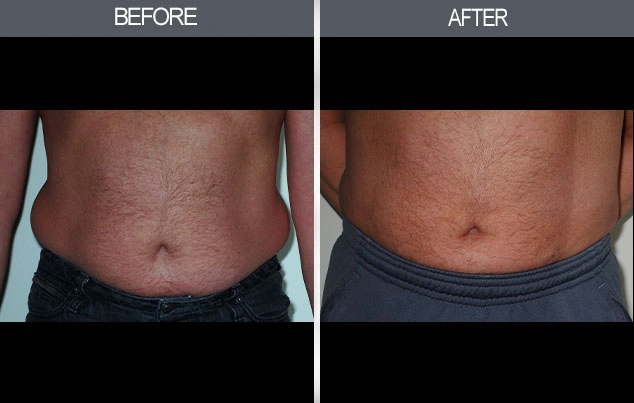 Real patient results in New York, NY Performed by Darrick E. Antell MD, FACS