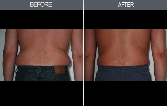 Real patient results in New York, NY Performed by Darrick E. Antell MD, FACS