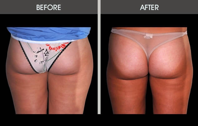 Real patient results in New York, NY Performed by Darrick E. Antell MD, FACS
