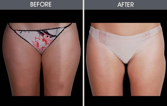 Real patient results in New York, NY Performed by Darrick E. Antell MD, FACS