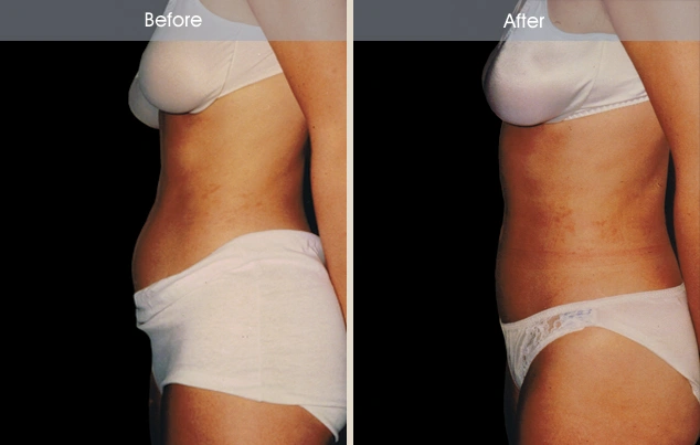 Real patient results in New York, NY Performed by Darrick E. Antell MD, FACS