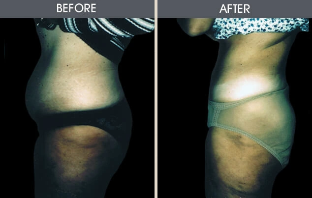 Real patient results in New York, NY Performed by Darrick E. Antell MD, FACS