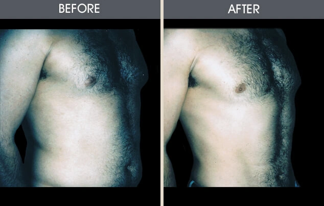 Real patient results in New York, NY Performed by Darrick E. Antell MD, FACS
