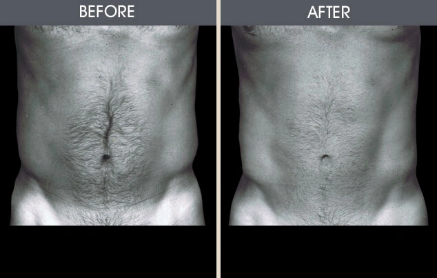 Real patient results in New York, NY Performed by Darrick E. Antell MD, FACS