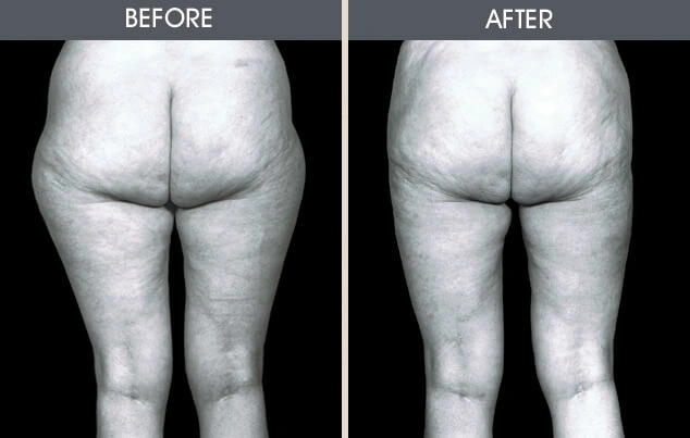 Real patient results in New York, NY Performed by Darrick E. Antell MD, FACS