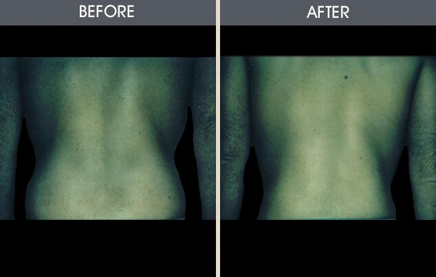 Real patient results in New York, NY Performed by Darrick E. Antell MD, FACS