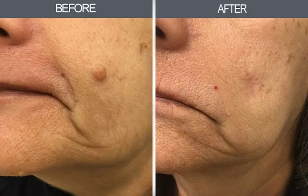 Real patient results in New York, NY Performed by Darrick E. Antell MD, FACS