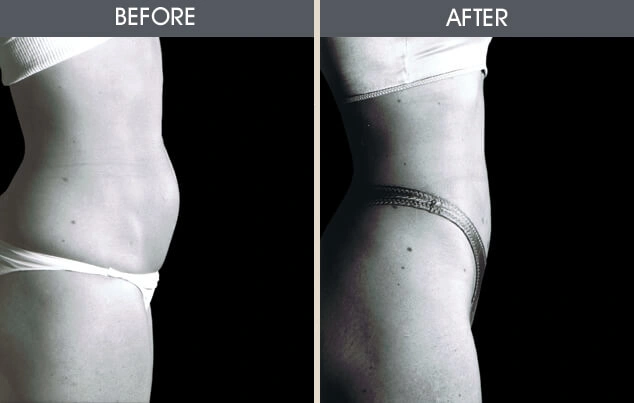 Real patient results in New York, NY Performed by Darrick E. Antell MD, FACS