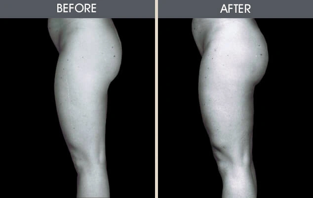 Real patient results in New York, NY Performed by Darrick E. Antell MD, FACS