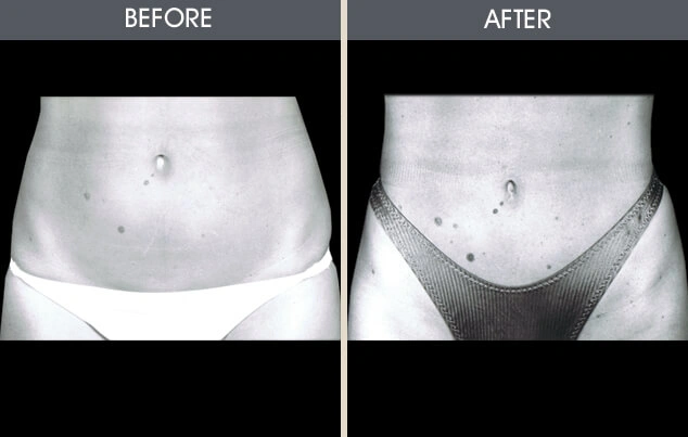 Real patient results in New York, NY Performed by Darrick E. Antell MD, FACS