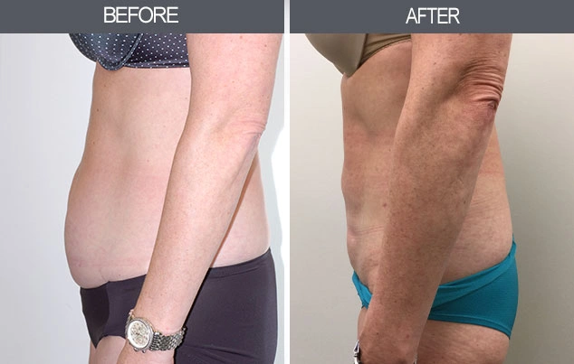 Real patient results in New York, NY Performed by Darrick E. Antell MD, FACS