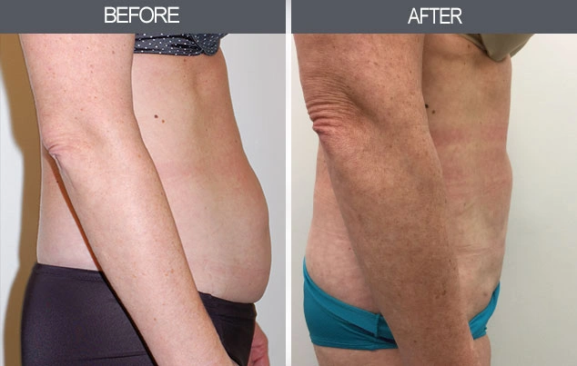 Real patient results in New York, NY Performed by Darrick E. Antell MD, FACS
