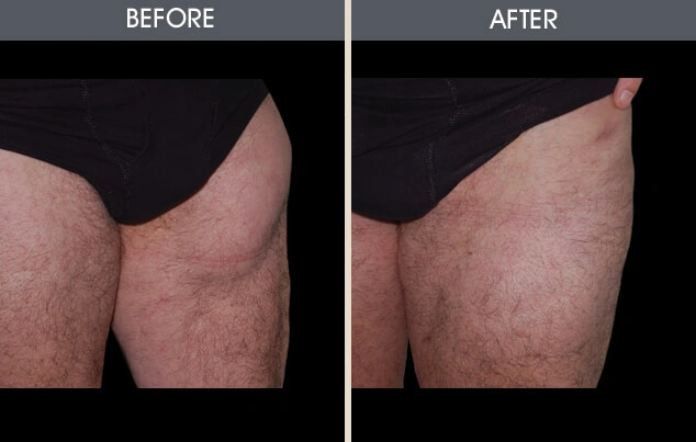 Real patient results in New York, NY Performed by Darrick E. Antell MD, FACS