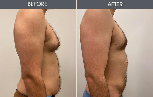 Real patient results in New York, NY Performed by Darrick E. Antell MD, FACS