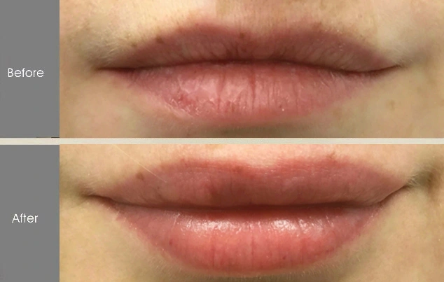 Real patient results in New York, NY Performed by Darrick E. Antell MD, FACS