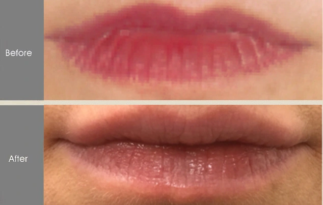 Real patient results in New York, NY Performed by Darrick E. Antell MD, FACS