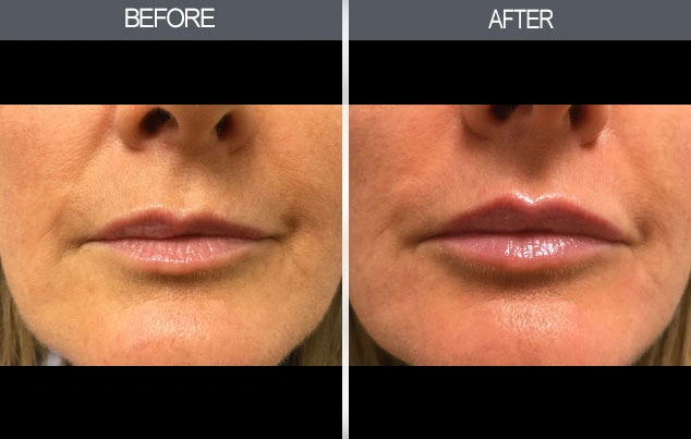 Real patient results in New York, NY Performed by Darrick E. Antell MD, FACS