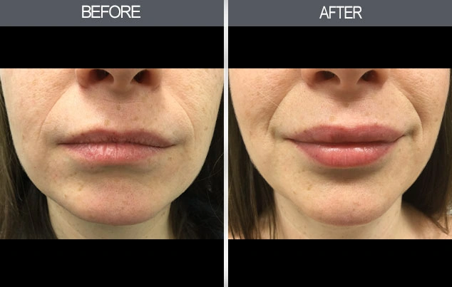 Real patient results in New York, NY Performed by Darrick E. Antell MD, FACS