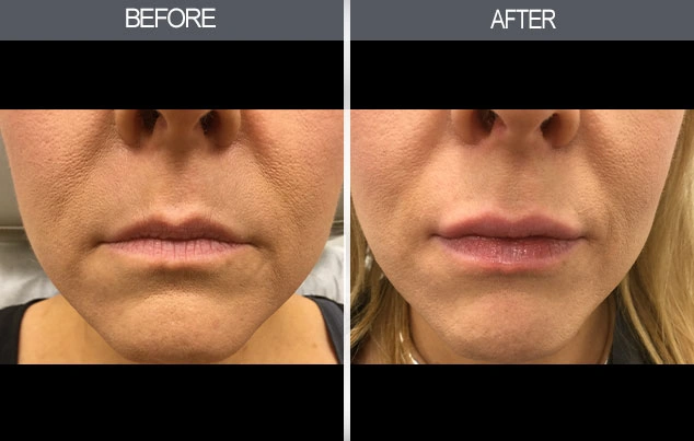 Real patient results in New York, NY Performed by Darrick E. Antell MD, FACS