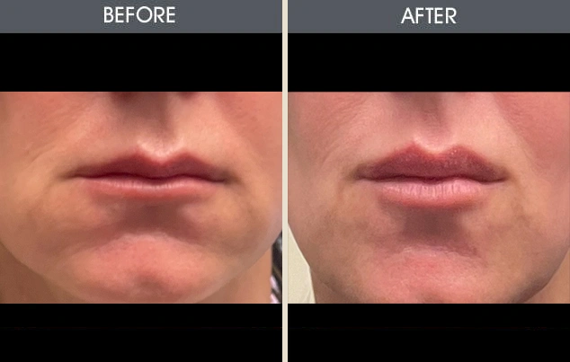 Real patient results in New York, NY Performed by Darrick E. Antell MD, FACS