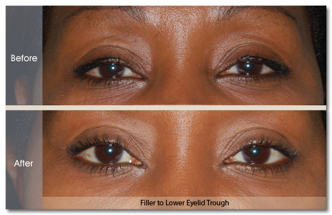 Real patient results in New York, NY Performed by Darrick E. Antell MD, FACS