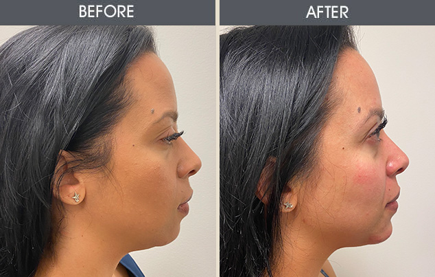 Real patient results in New York, NY Performed by Darrick E. Antell MD, FACS