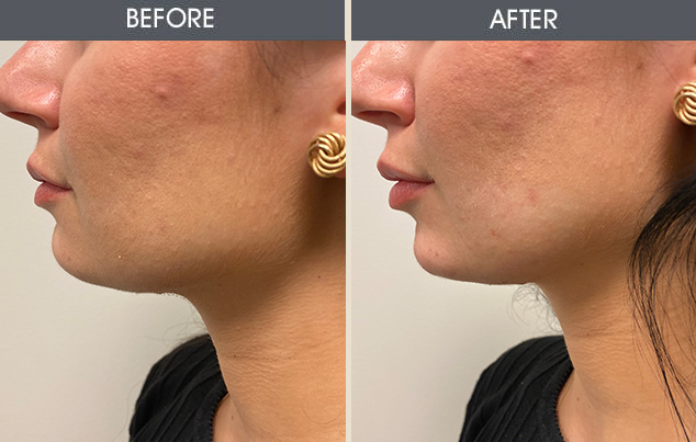 Real patient results in New York, NY Performed by Darrick E. Antell MD, FACS
