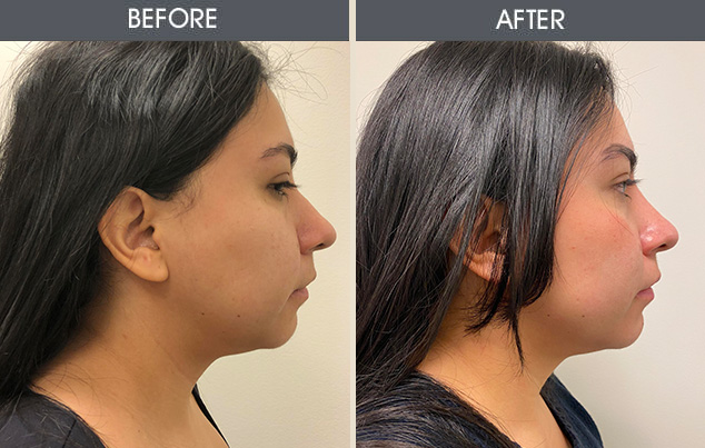 Real patient results in New York, NY Performed by Darrick E. Antell MD, FACS