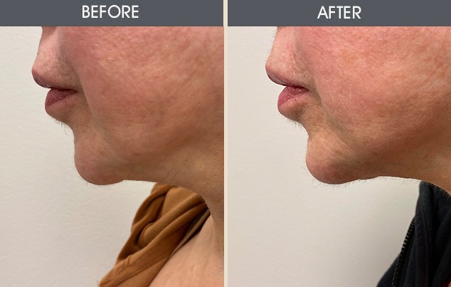 Real patient results in New York, NY Performed by Darrick E. Antell MD, FACS