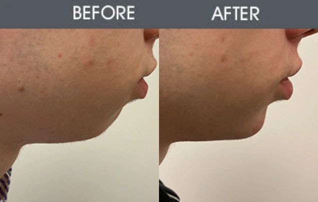 Real patient results in New York, NY Performed by Darrick E. Antell MD, FACS