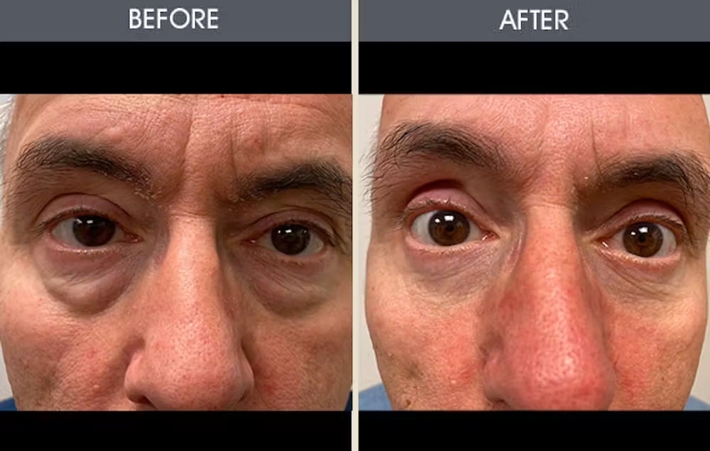 Real patient results in New York, NY Performed by Darrick E. Antell MD, FACS