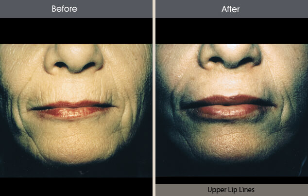 Real patient results in New York, NY Performed by Darrick E. Antell MD, FACS