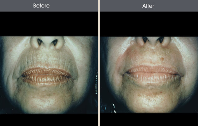 Real patient results in New York, NY Performed by Darrick E. Antell MD, FACS
