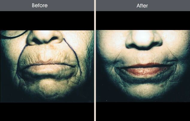 Real patient results in New York, NY Performed by Darrick E. Antell MD, FACS