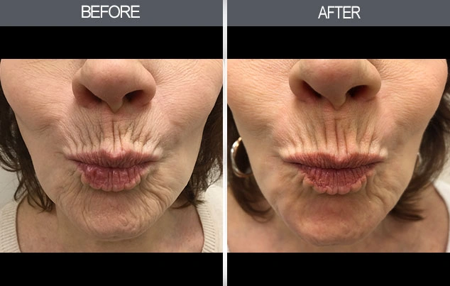 Real patient results in New York, NY Performed by Darrick E. Antell MD, FACS