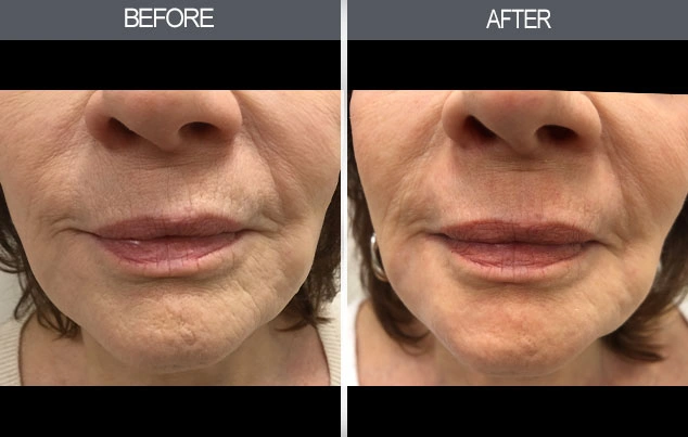 Real patient results in New York, NY Performed by Darrick E. Antell MD, FACS