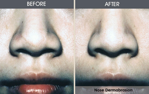 Real patient results in New York, NY Performed by Darrick E. Antell MD, FACS
