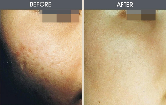 Real patient results in New York, NY Performed by Darrick E. Antell MD, FACS