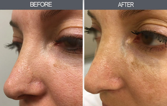 Real patient results in New York, NY Performed by Darrick E. Antell MD, FACS