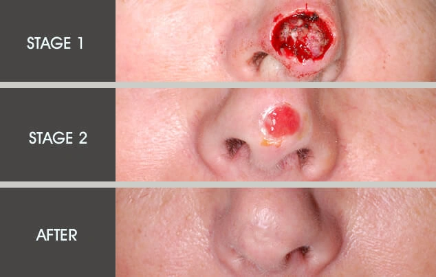 Real patient results in New York, NY Performed by Darrick E. Antell MD, FACS