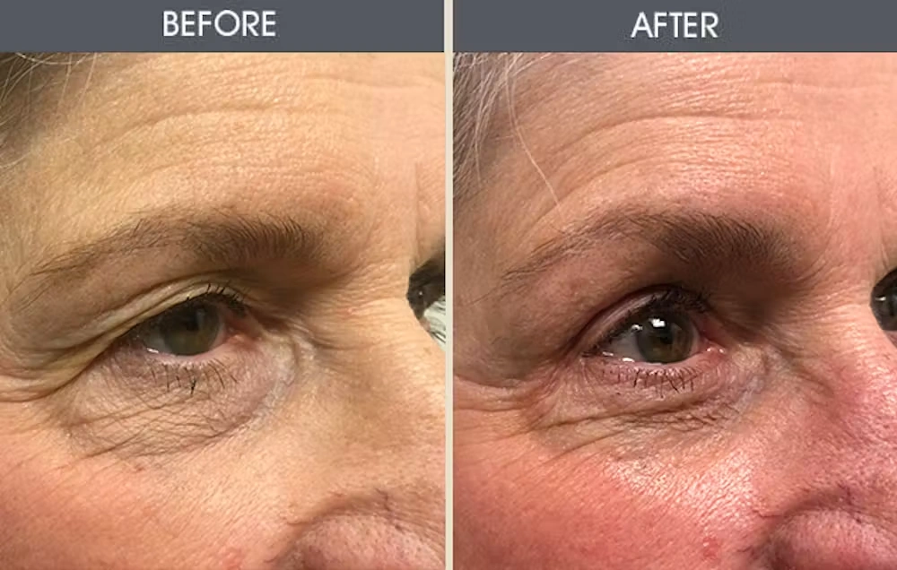 Real patient results in New York, NY Performed by Darrick E. Antell MD, FACS