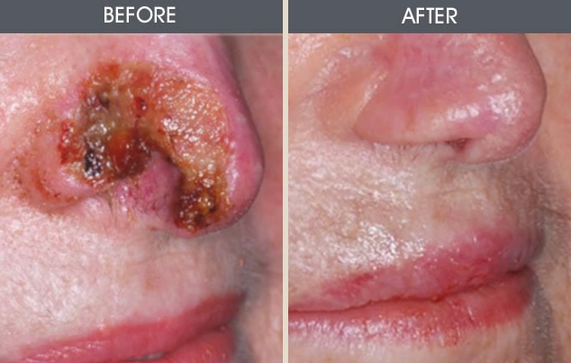Real patient results in New York, NY Performed by Darrick E. Antell MD, FACS