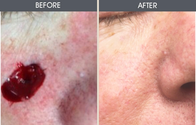 Real patient results in New York, NY Performed by Darrick E. Antell MD, FACS