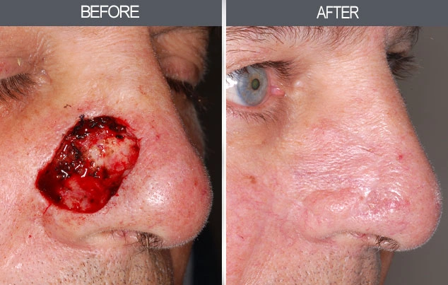 Real patient results in New York, NY Performed by Darrick E. Antell MD, FACS