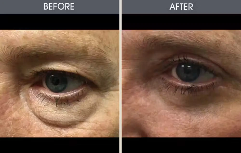 Real patient results in New York, NY Performed by Darrick E. Antell MD, FACS