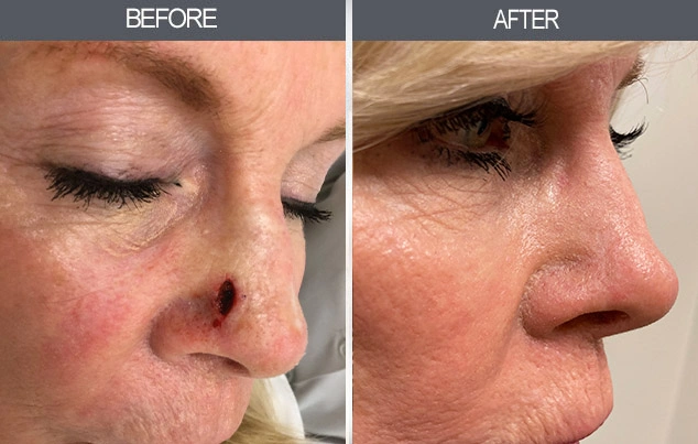 Real patient results in New York, NY Performed by Darrick E. Antell MD, FACS